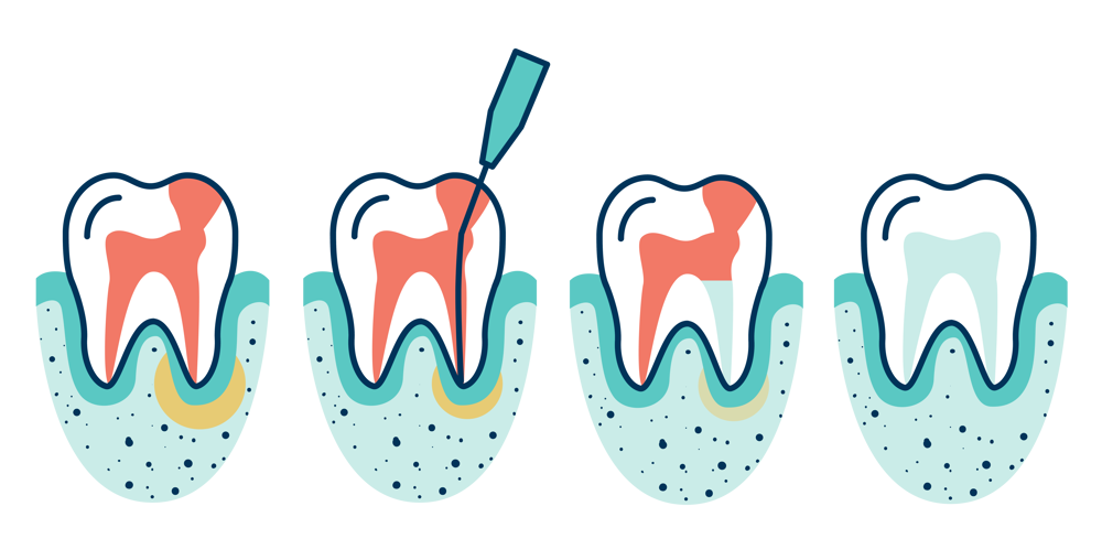 Root Canals